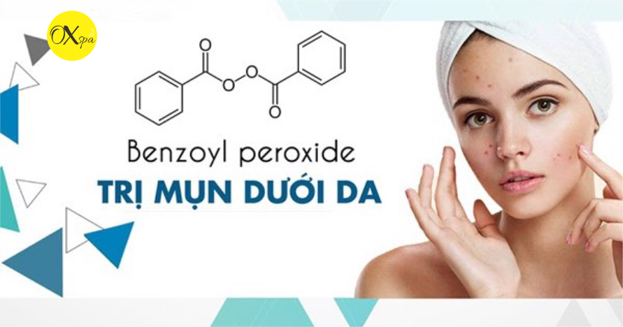 Benzoyl peroxide có trị được mụn