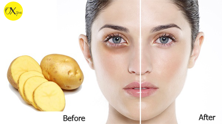 Cách khử bọng, thâm mắt bằng khoai tây sống.