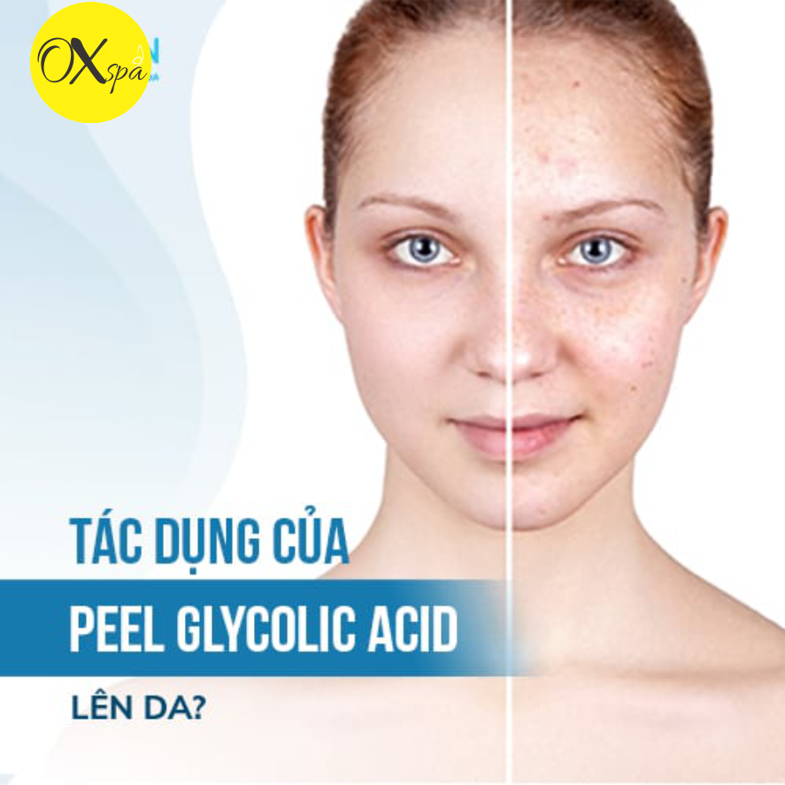 Công dụng của peel da glycolic acid cho làn da mụn