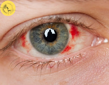 Tác hại của việc mổ mắt cận thị