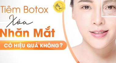 Tiêm Botox xoá nhăn mắt có hiệu quả và an toàn